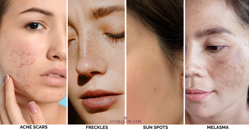 hyperpigmentation face photos