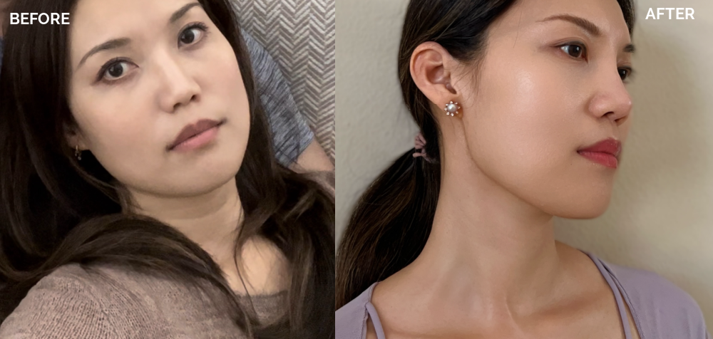 How to get rid of neck lines fast: treatment and prevention for deep neck wrinkles neck tightening before and after