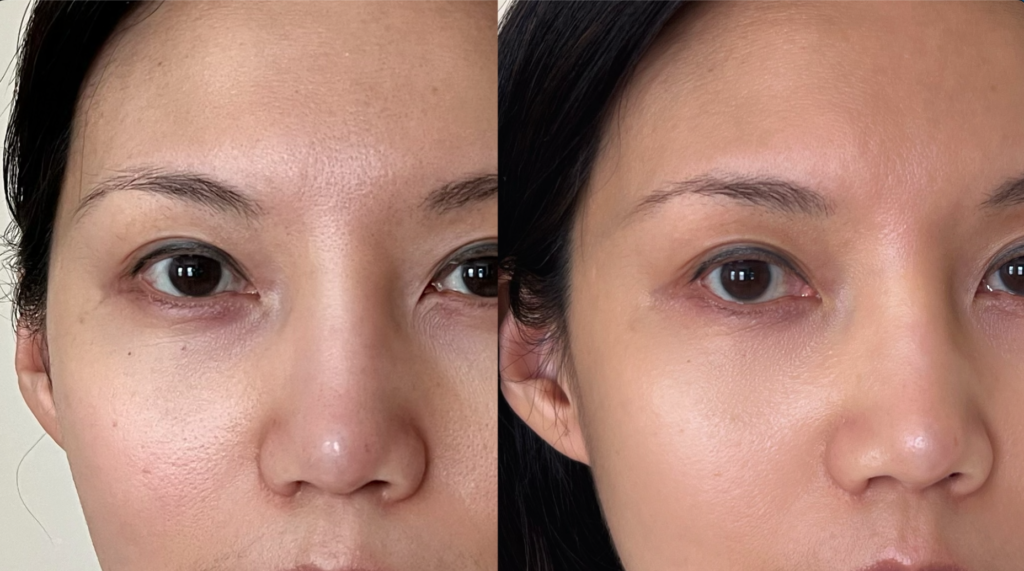 Project E Beauty LED Mask Reviews: I Used It for 10 Weeks—Here's What Actually Happened led face mask before and after wrinkles