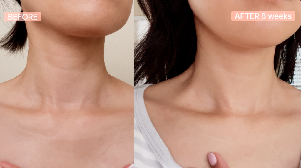Project E Beauty LED Mask Reviews: I Used It for 10 Weeks—Here's What Actually Happened neck led face mask before and after wrinkles
