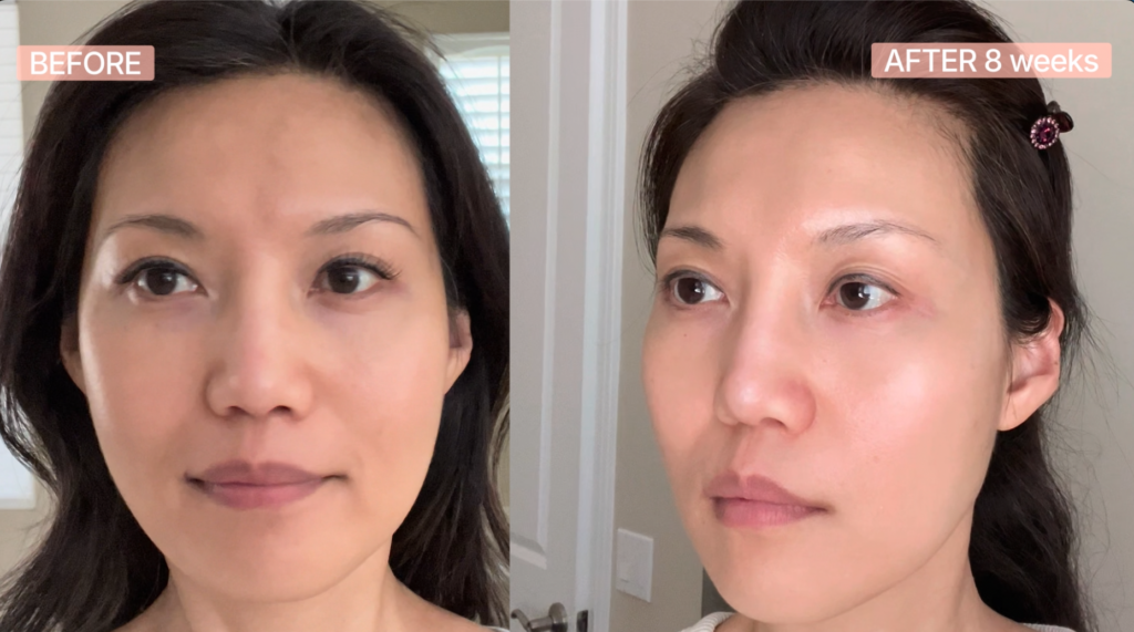 Project E Beauty LED Mask Reviews: I Used It for 10 Weeks—Here's What Actually Happened led face mask before and after